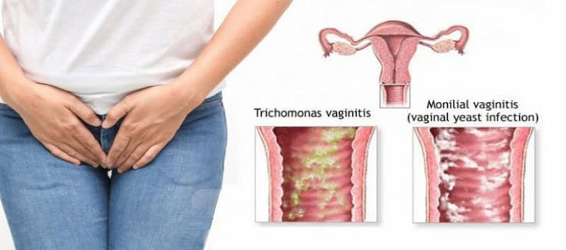 Ở phụ nữ, nhiễm Trichomonas thường có triệu trứng dịch tiết âm đạo có mủ, có mùi hôi kèm cảm giác nóng rát, ngứa, tiểu khó,...